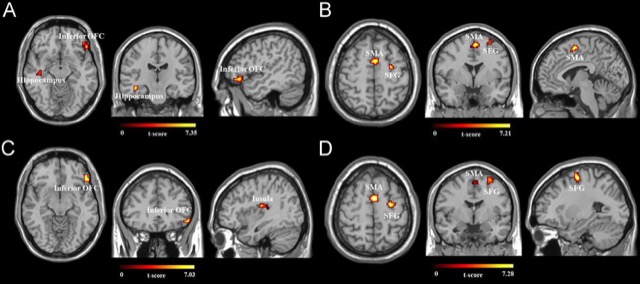 Brain regions showing altered roles in the default mode network after frontopolar tDCS